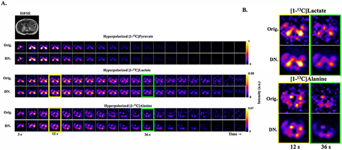 This scan captures dynamic hyperpolarized 13C MRI data from the abdomen of a healthy volunteer, showing signals from pyruvate, lactate, and alanine over time.